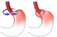 Cirugía antirreflujo, hernias hiatales