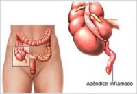 Apendicectomía (precio a convenir)