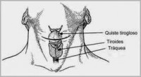 Cirugía para quiste tirogloso, quistes benignos en cuello.